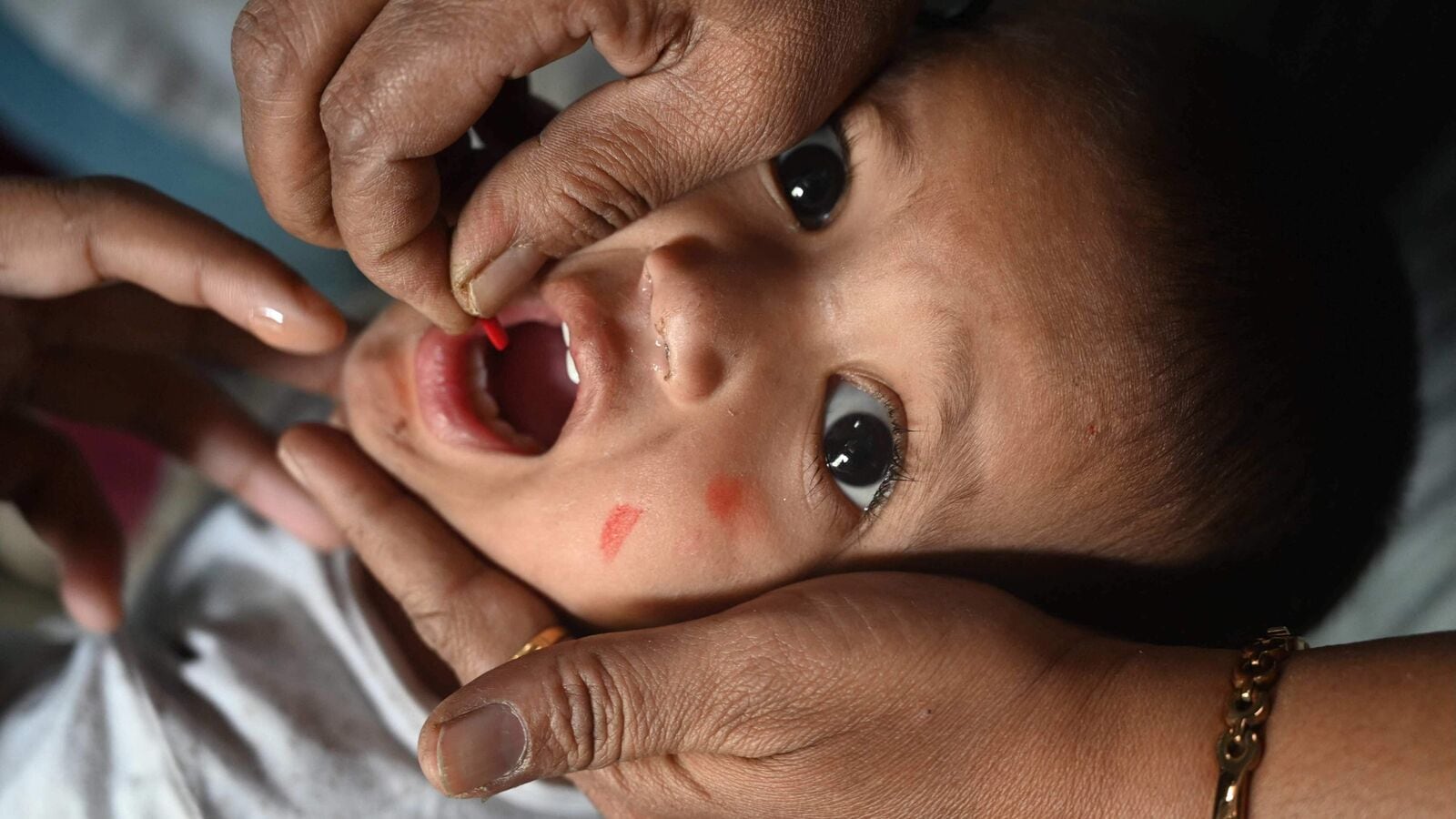 হাম রোগীদের জন্য আলাদা ওয়ার্ড চালু বাধ্যতামূলক