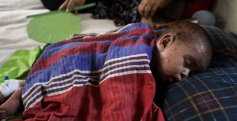 হামের উপসর্গে আরও ৫ শিশুর মৃত্যু, আক্রান্ত ২৪৩