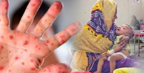 হামে আরও ৩ শিশুর মৃত্যু, আক্রান্ত হাজারেরও বেশি